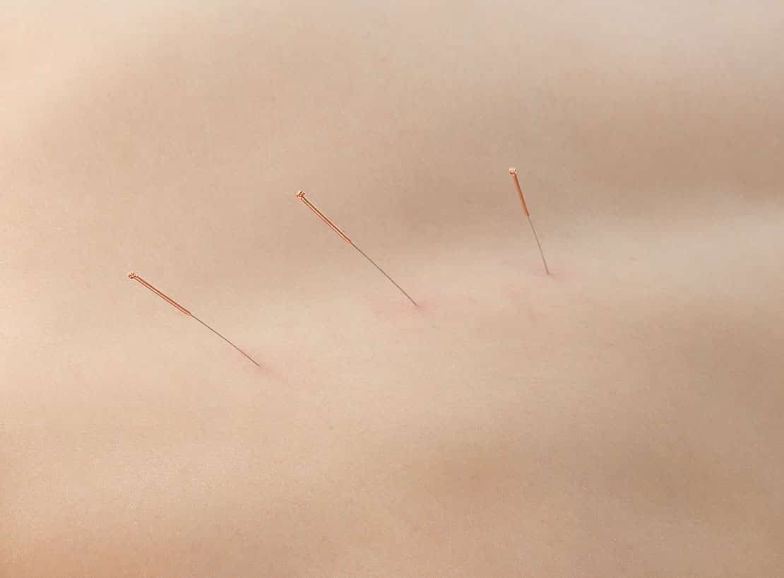 Akupunktur – die große Macht der kleinen Nadeln