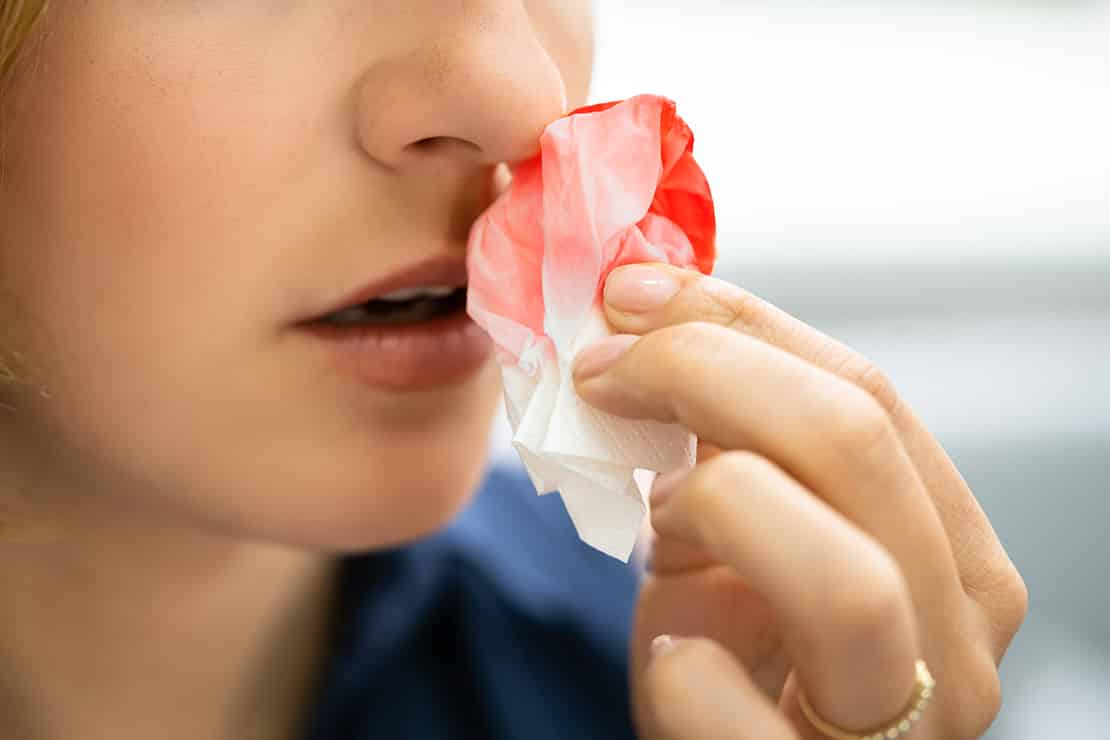Was hilft bei Nasenbluten und was nicht?